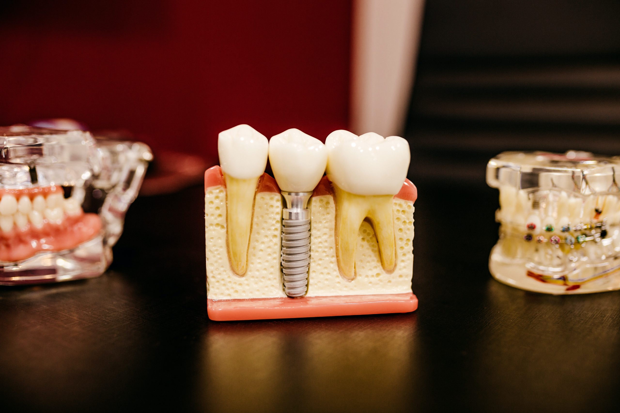 dental implants houston tx